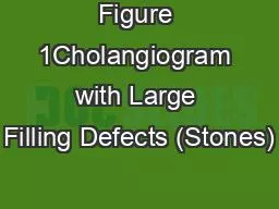 Figure 1Cholangiogram with Large Filling Defects (Stones)