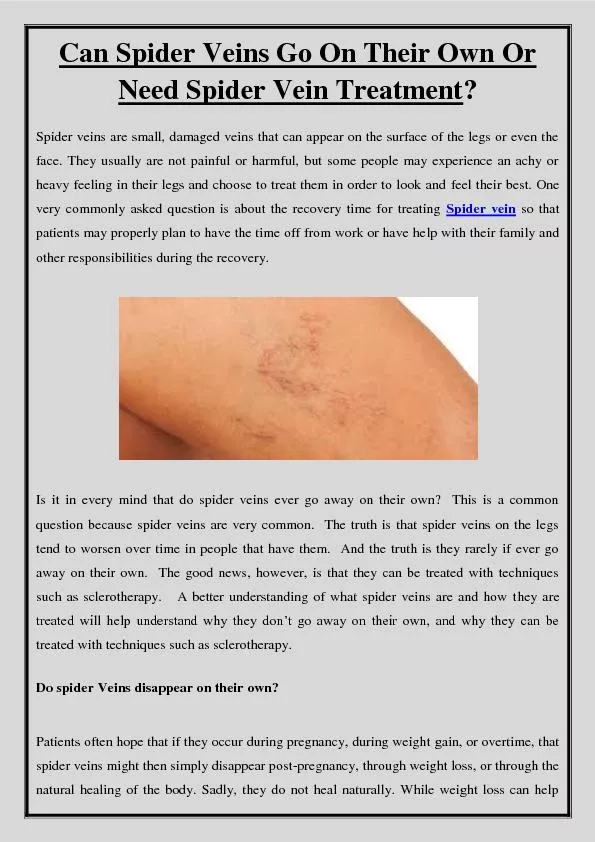 Can Spider Veins Go On Their Own Or Need Spider Vein Treatment?