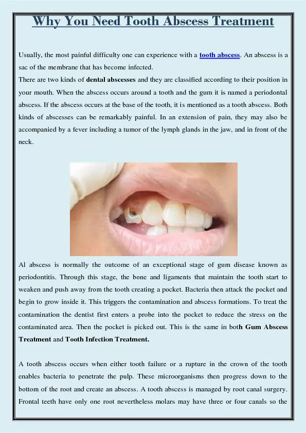 Why you need tooth abscess treatment