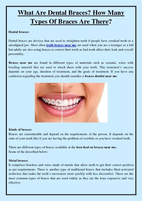 What Are Dental Braces? How Many Types Of Braces Are There?