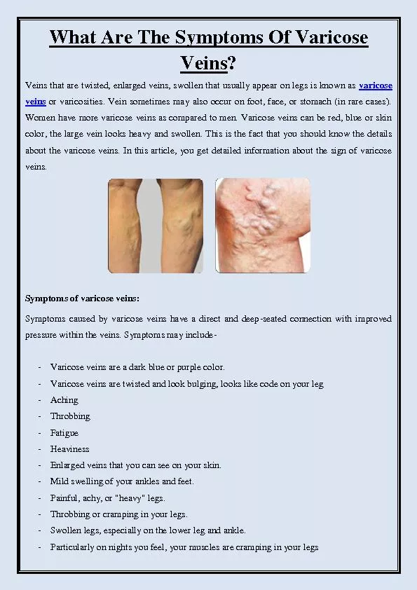 What are the Symptoms of Varicose Veins?