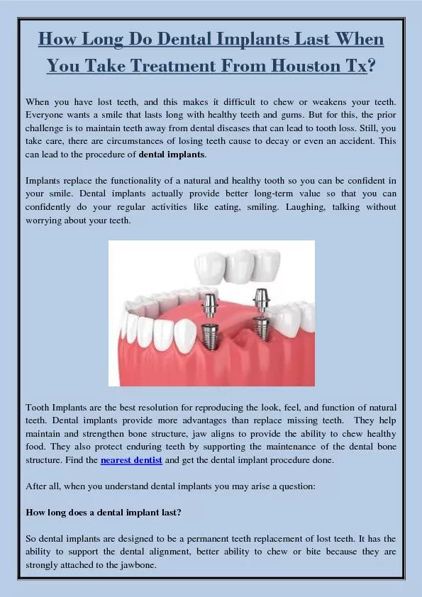 How Long Do Dental Implants Last When You Take Treatment From Houston Tx?