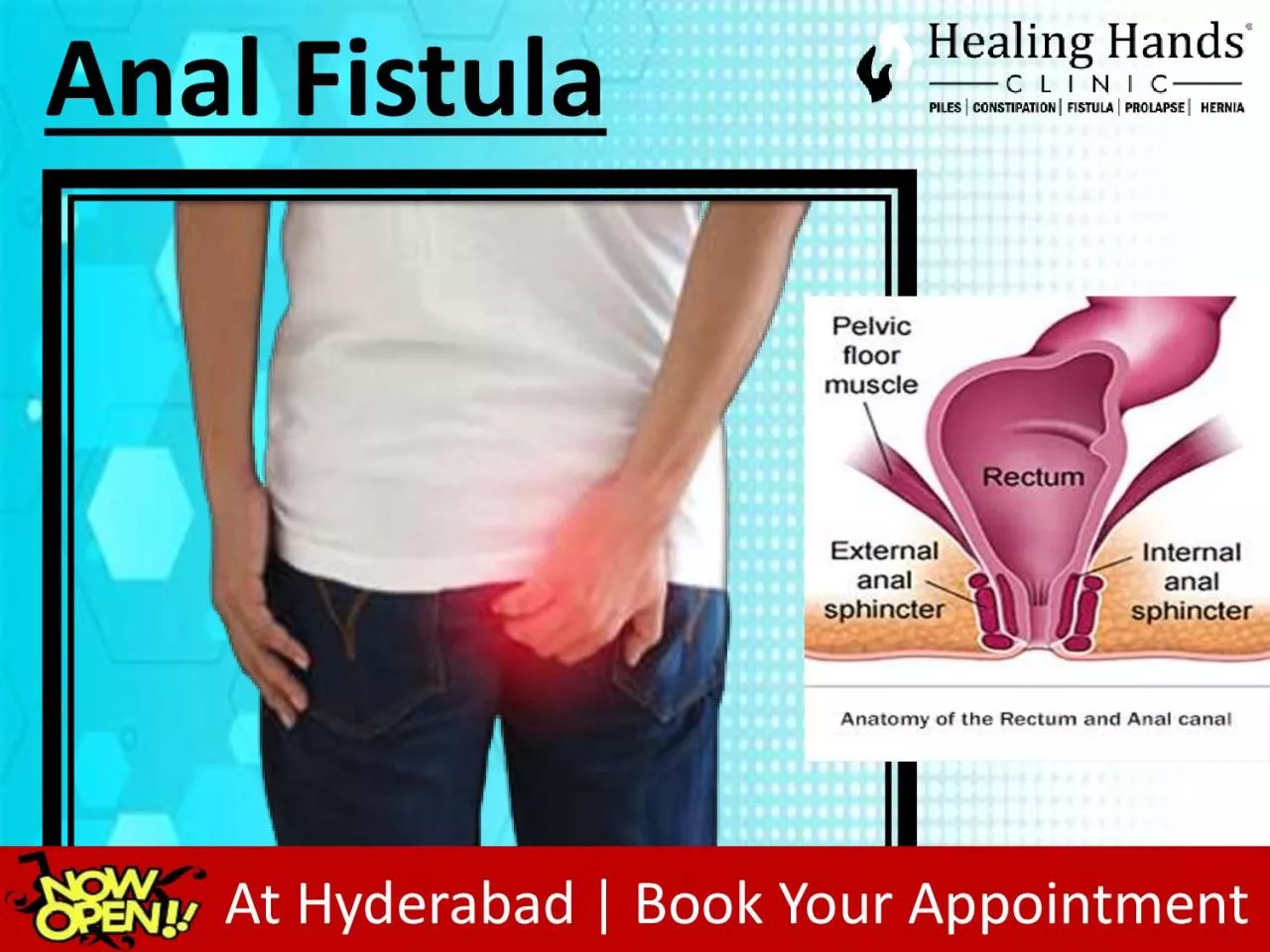 PDF-Anal Fistula Treatment in Hyderabad