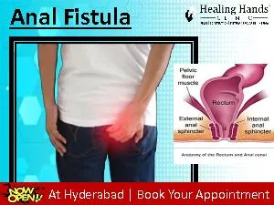 Anal Fistula Treatment in Hyderabad