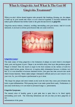 What Is Gingivitis And What Is The Cost Of Gingivitis Treatment?
