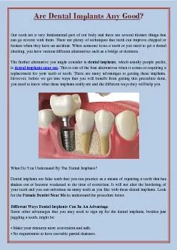 Are Dental Implants Any Good?