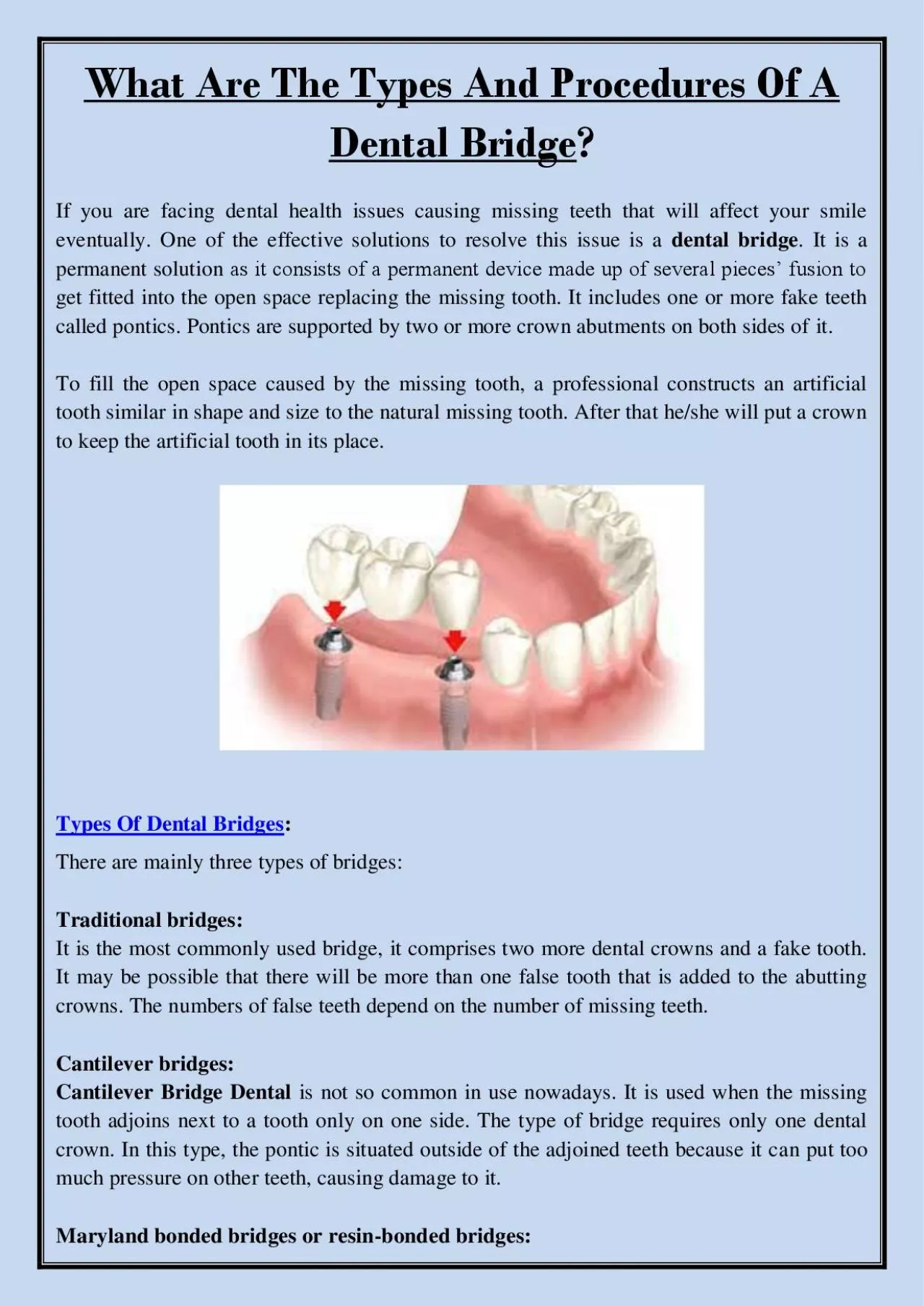 PDF-What Are The Types And Procedures Of A Dental Bridge?