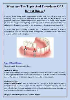 What Are The Types And Procedures Of A Dental Bridge?