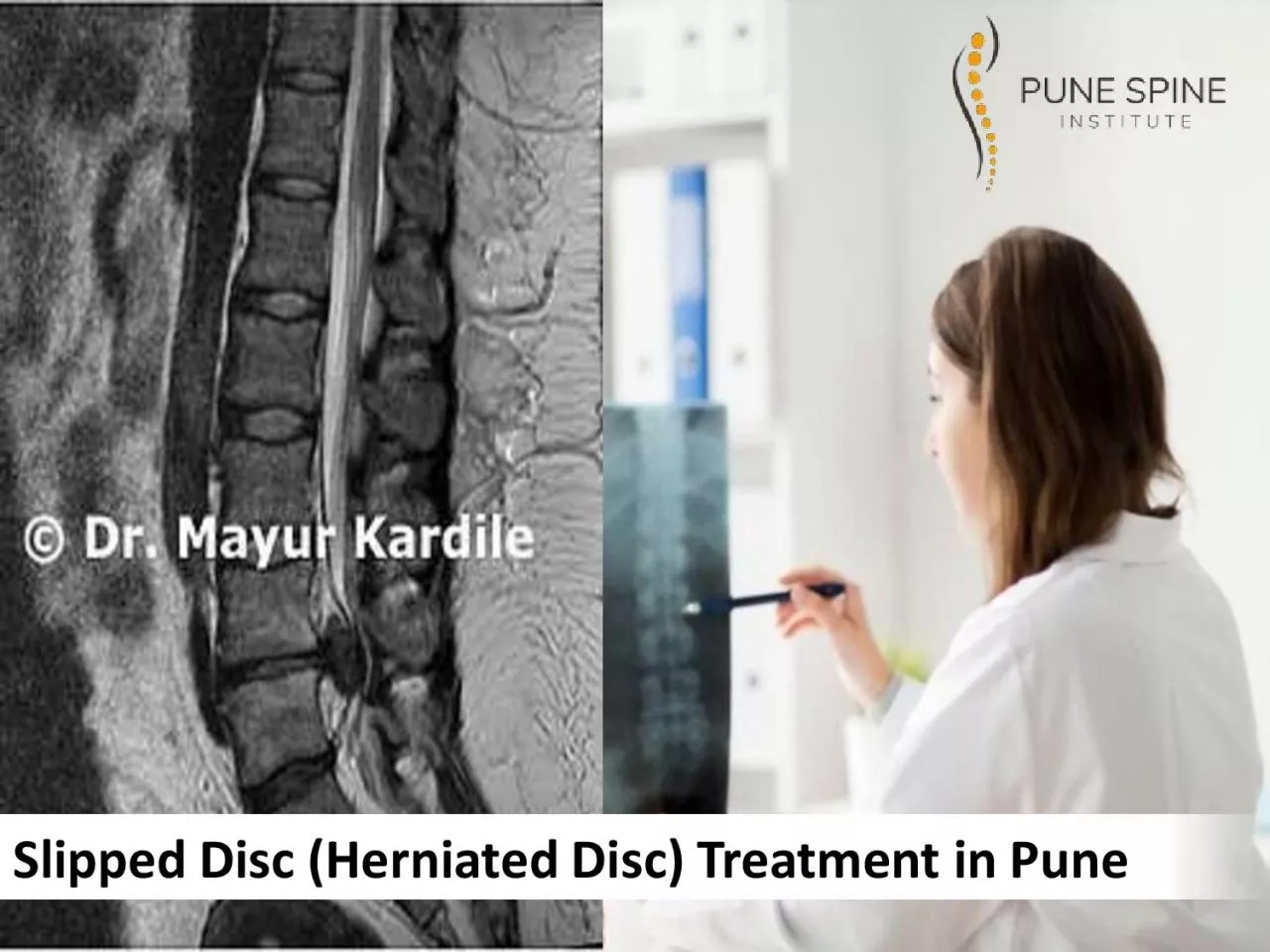 PDF-Best Slipped Disc Treatment in Pune