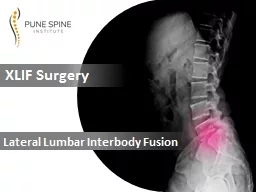 Best XLIF Surgery Treatment in Pune | Lateral Lumbar Interbody Fusion