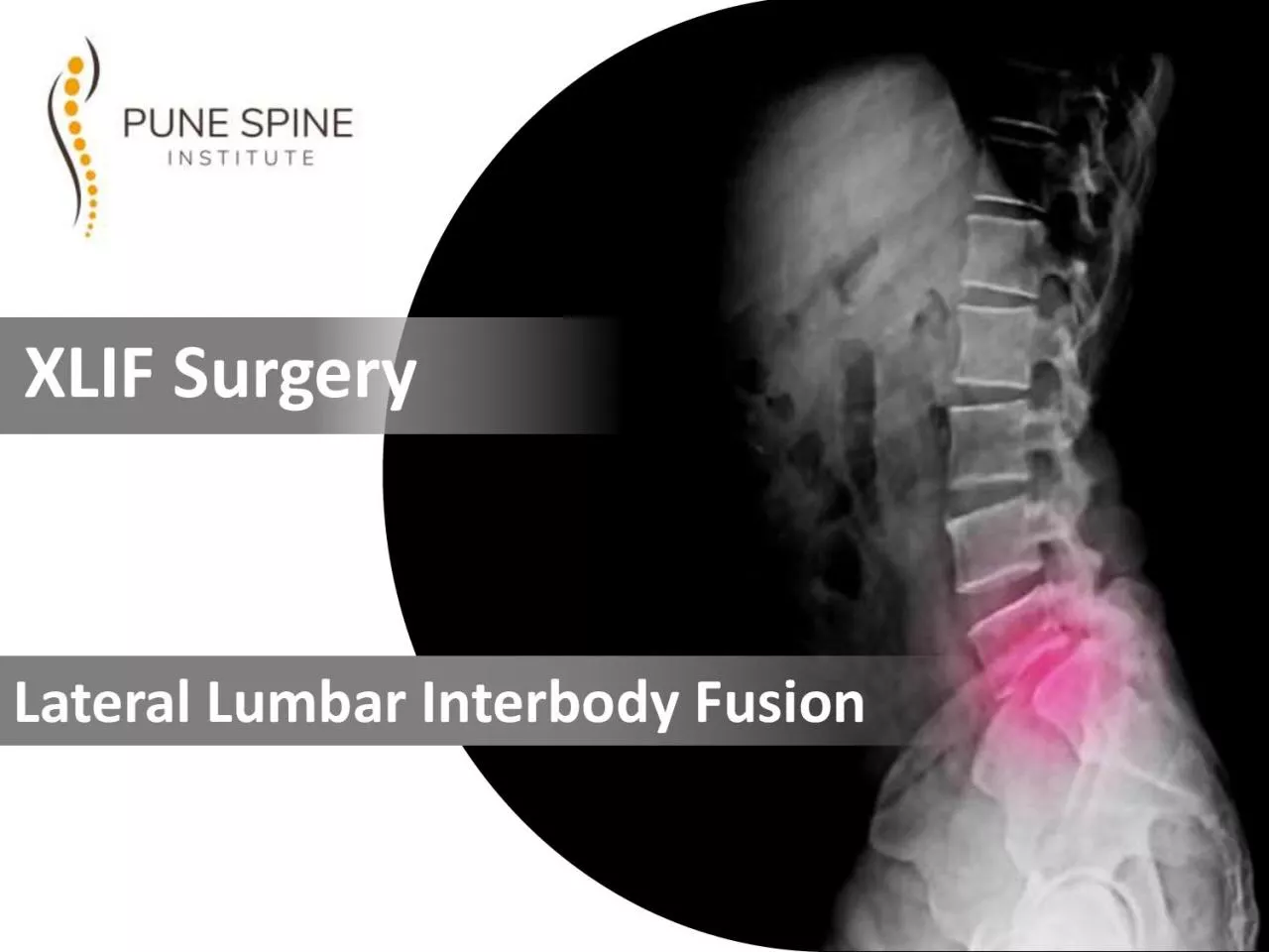 PDF-Best XLIF Surgery Treatment in Pune | Lateral Lumbar Interbody Fusion