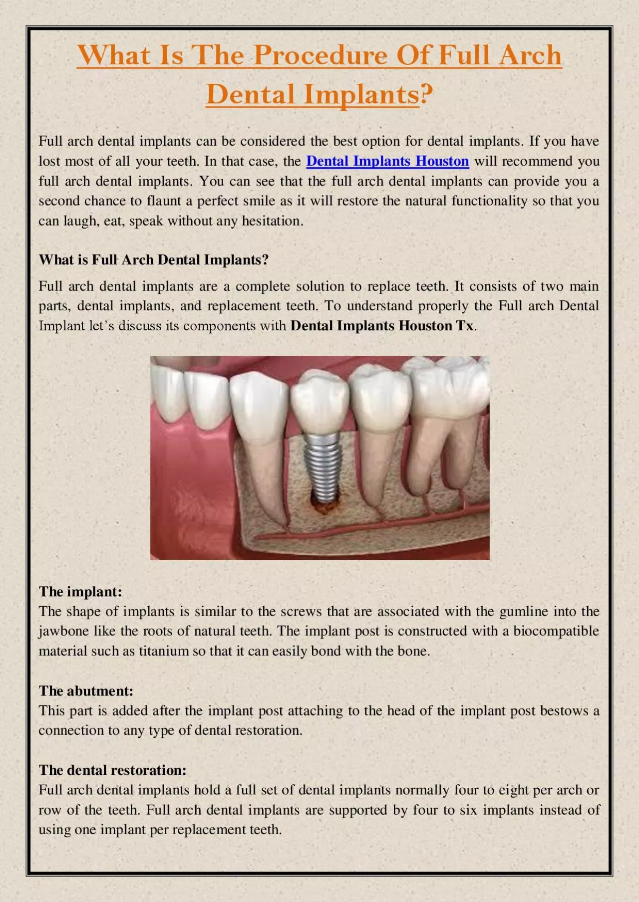 PDF-What Is The Procedure Of Full Arch Dental Implants?