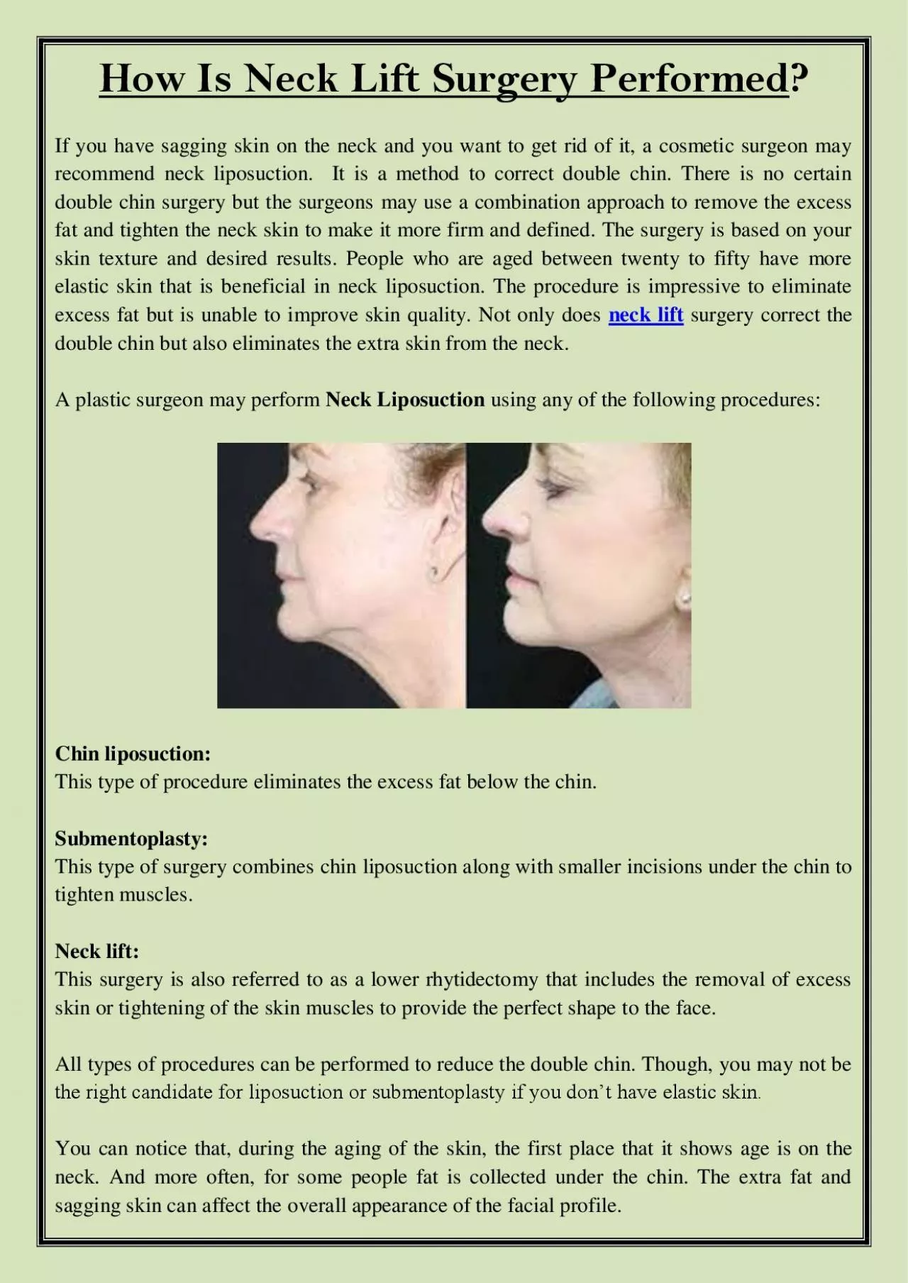 PDF-How Is Neck Lift Surgery Performed?