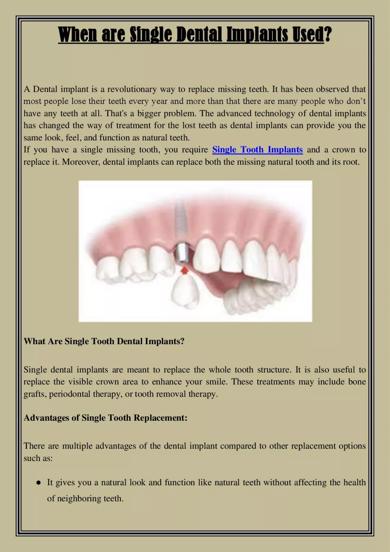 PDF-When are Single Dental Implants Used?