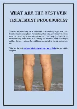 What are the best vein treatment procedures?