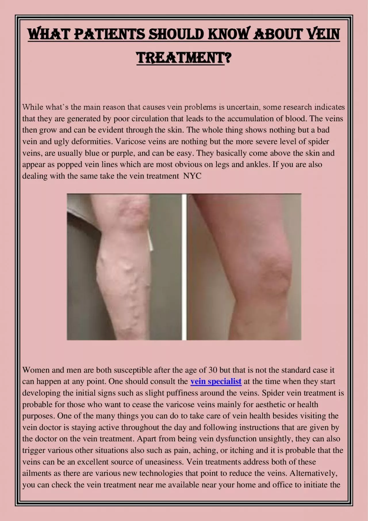 PDF-What Patients Should Know About Vein Treatment?