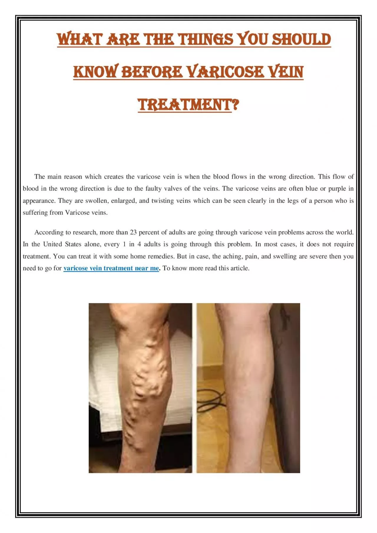 PDF-What are the things you should know before varicose vein treatment?