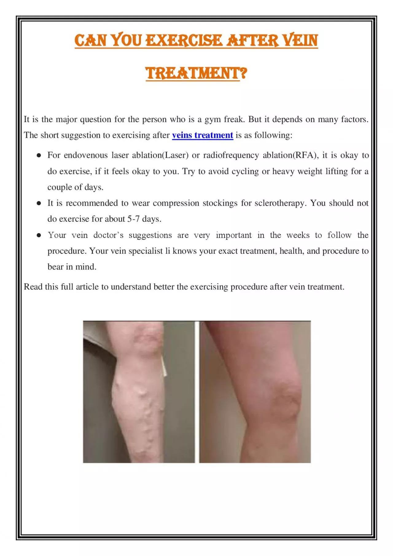 PDF-Can you exercise after vein treatment?