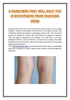 5 Exercises that will help you in recovering from varicose veins