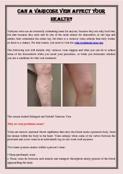 Can a Varicose Vein Affect Your Health?