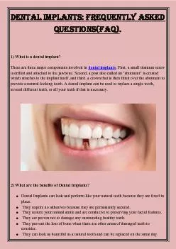 Dental implants: Frequently Asked Questions(FAQ).