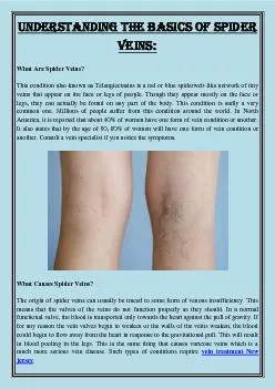 Understanding The Basics Of Spider Veins: