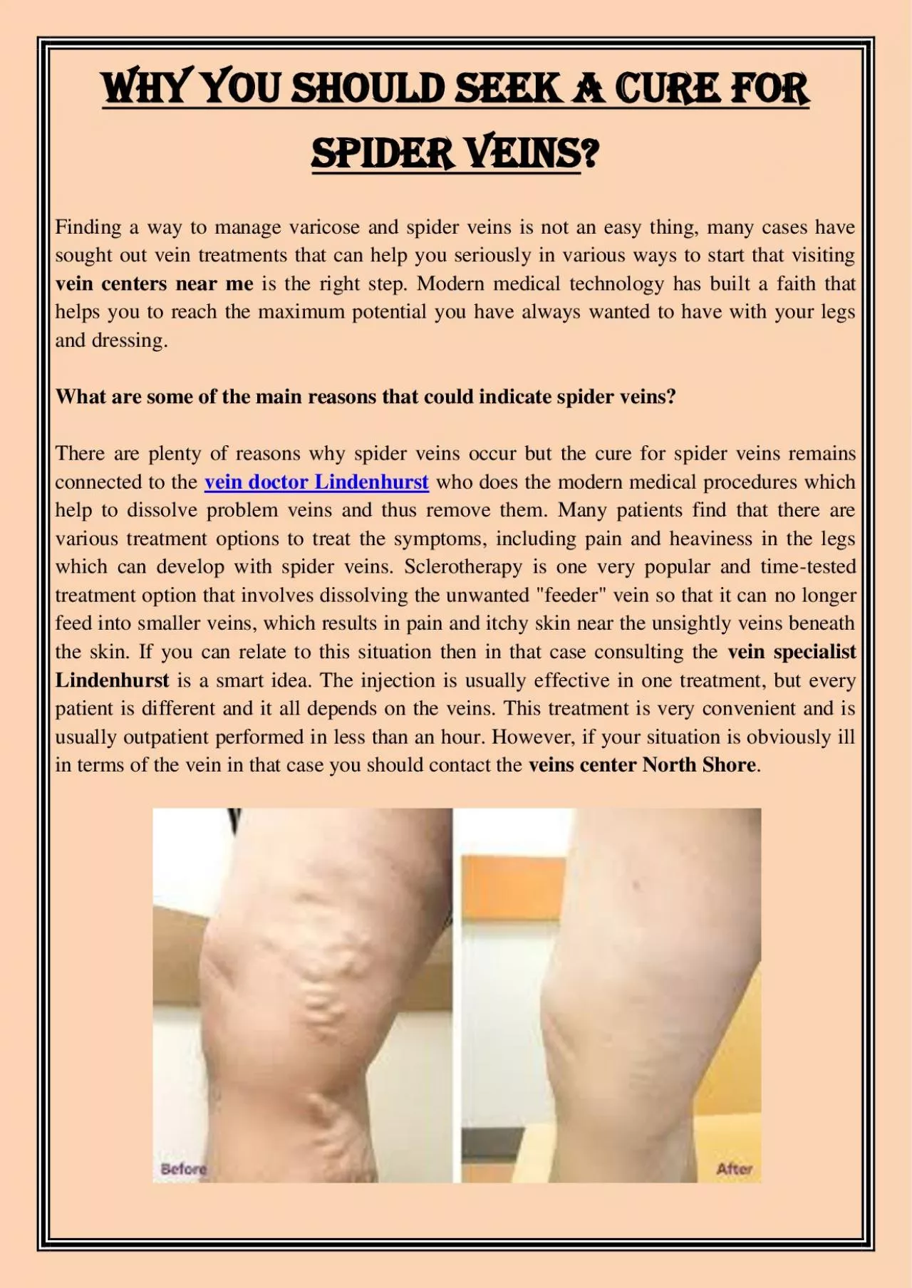 PDF-Why You Should Seek a Cure For Spider Veins?