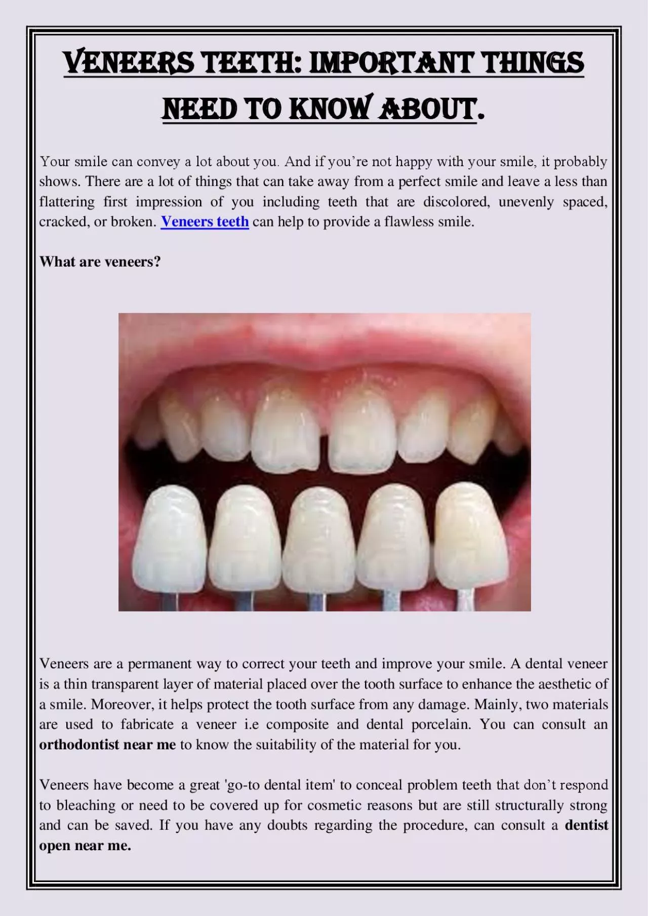 PDF-Veneers Teeth: Important Things Need To Know About.