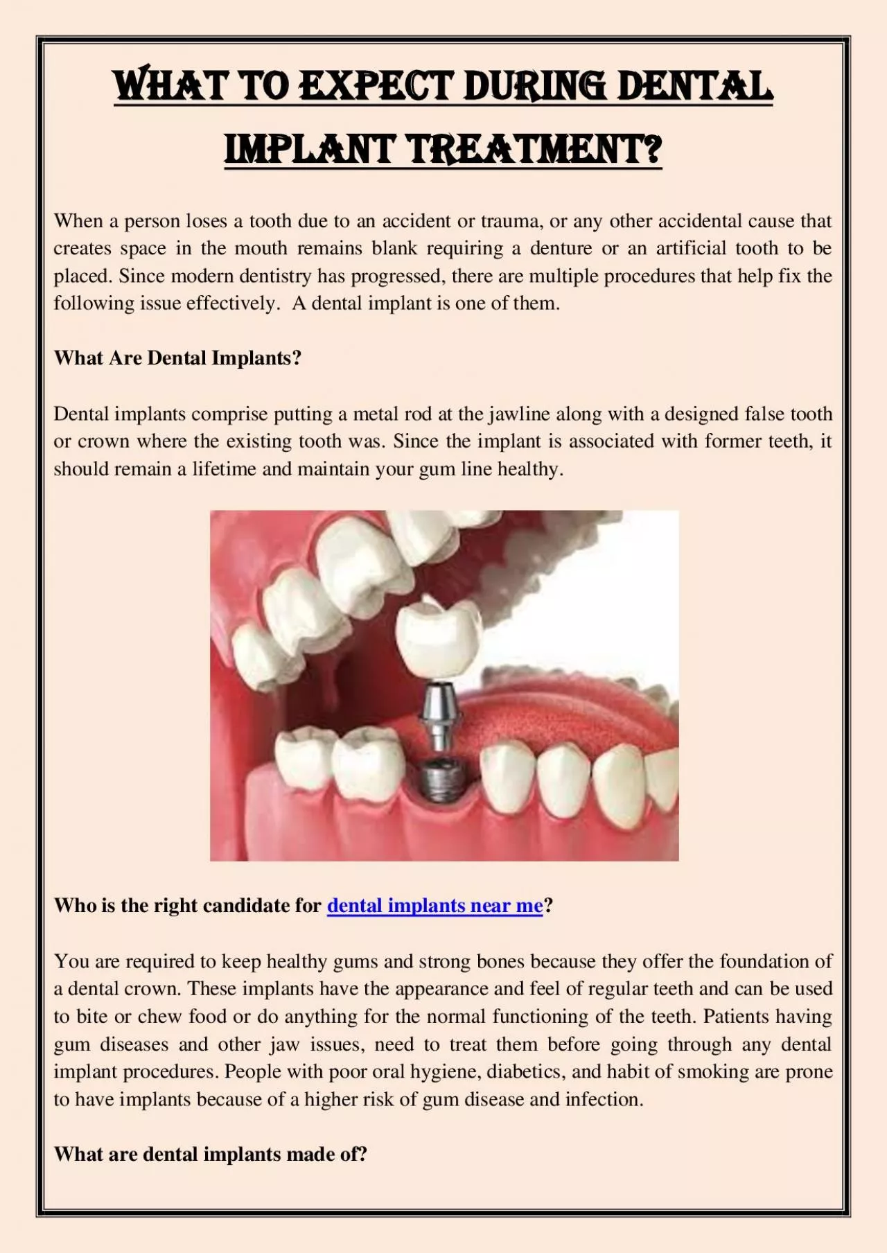 PDF-What To Expect During Dental Implant Treatment?