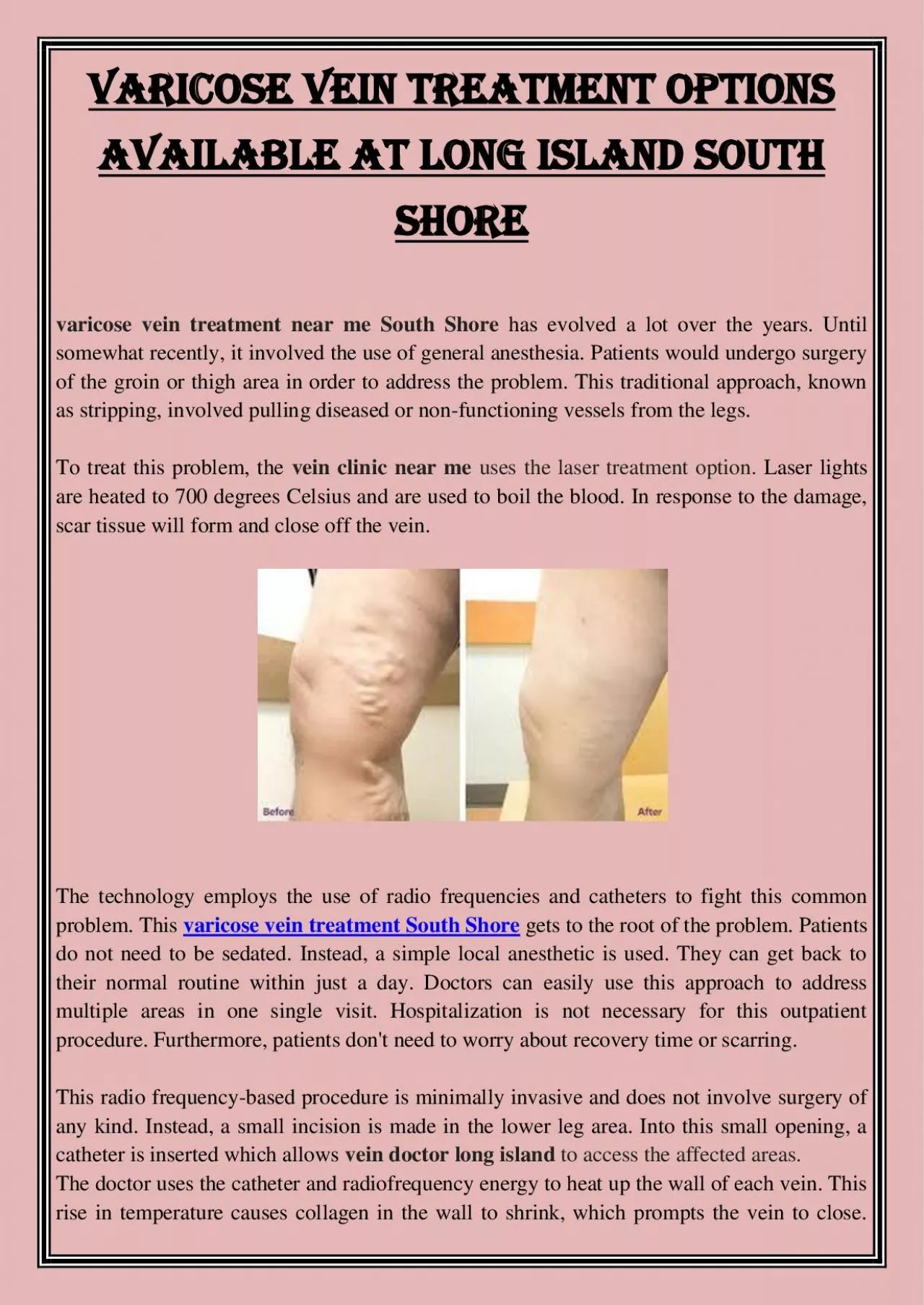 PDF-Varicose vein treatment options available at Long island south shore