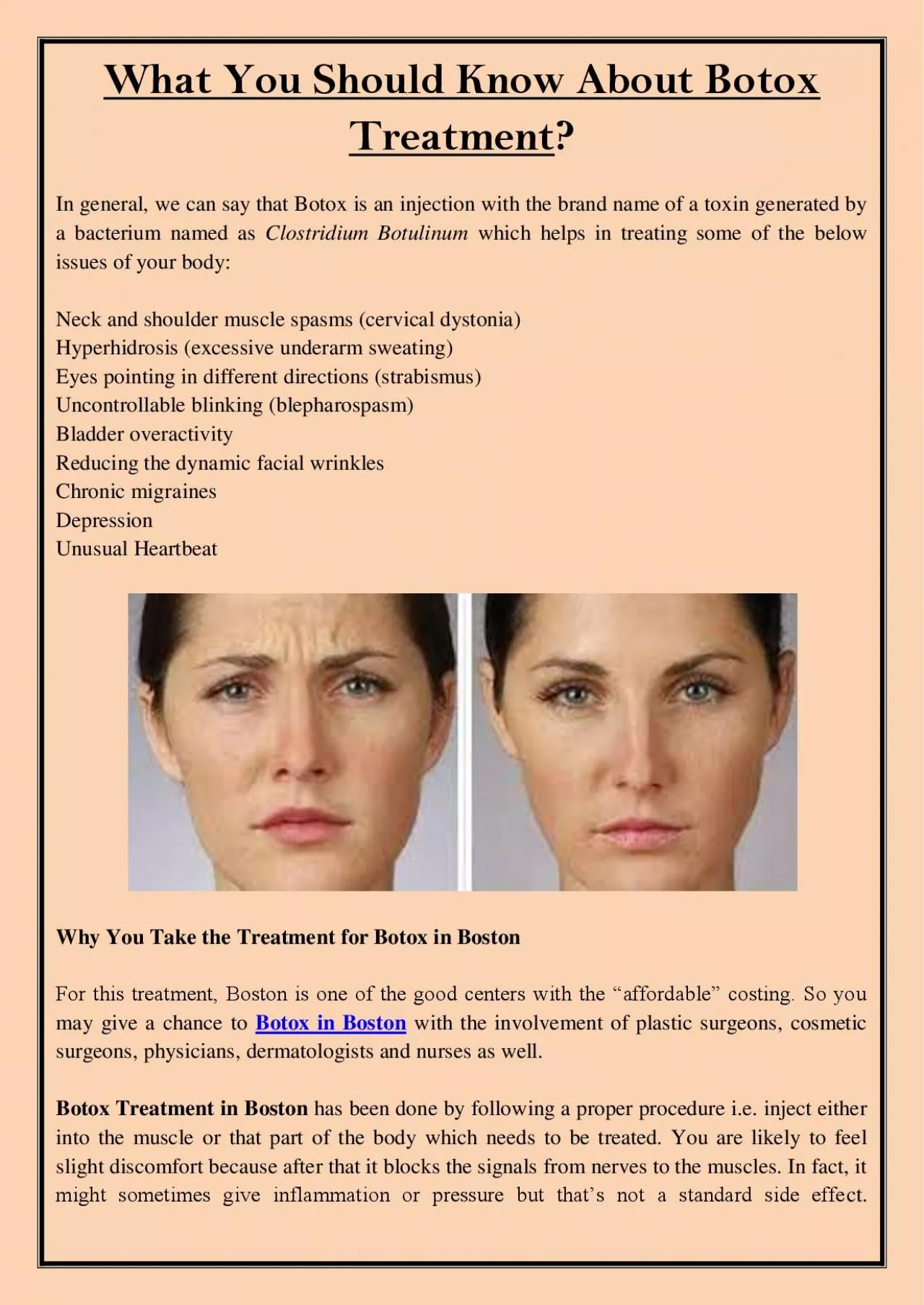 PDF-What You Should Know About Botox Treatment?