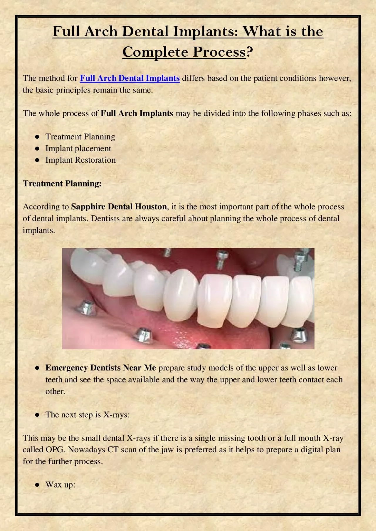 PDF-Full Arch Dental Implants: What is the Complete Process?