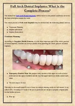 Full Arch Dental Implants: What is the Complete Process?