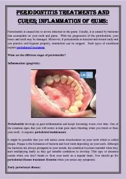 Periodontitis Treatments And Cures; Inflammation Of Gums: