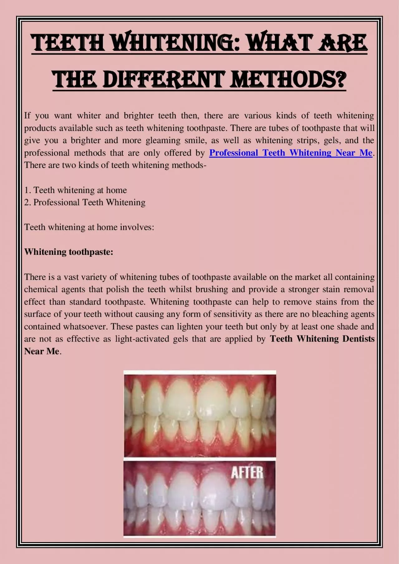 PDF-Teeth Whitening: What are the different methods?