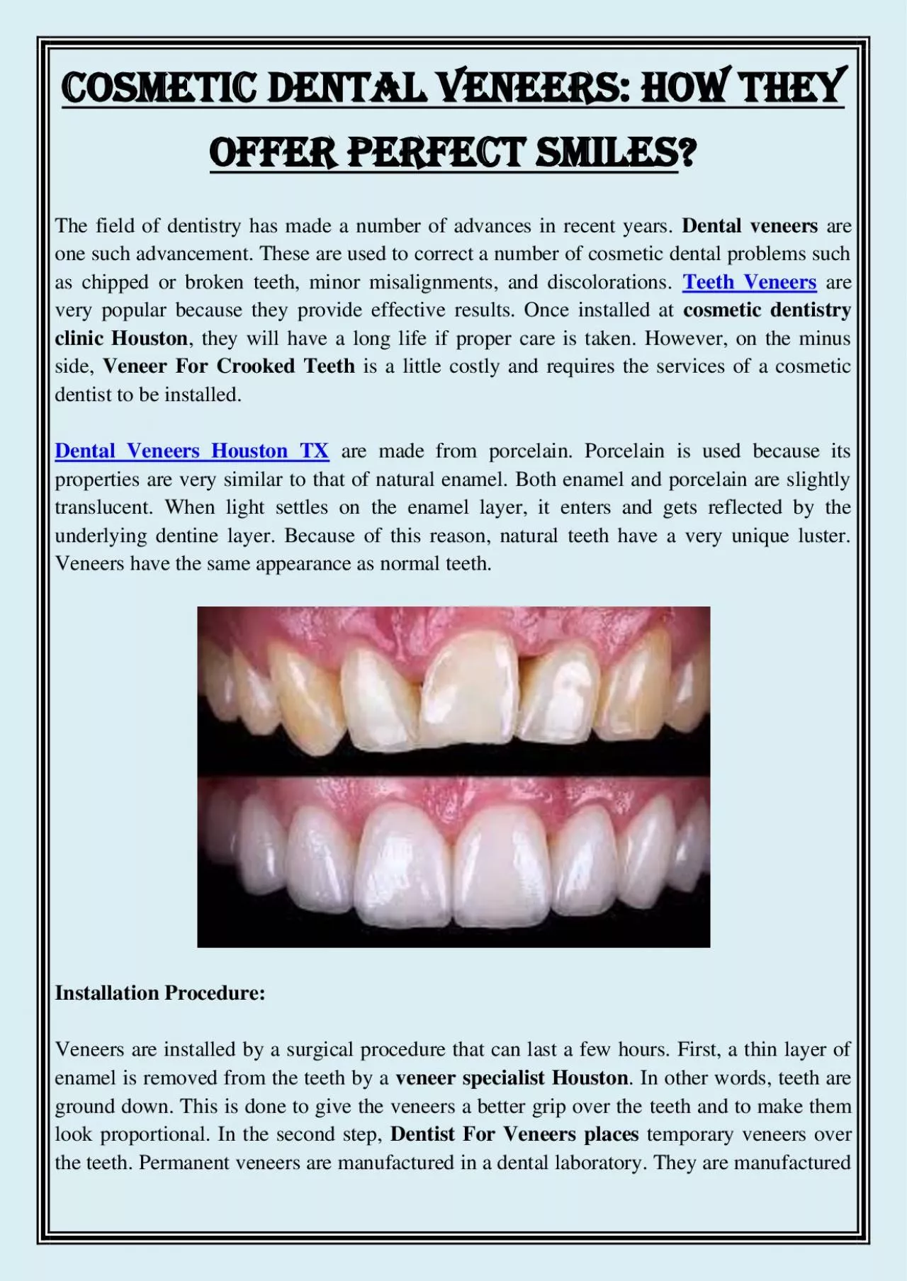 PDF-Cosmetic Dental Veneers: How They Offer Perfect Smiles?