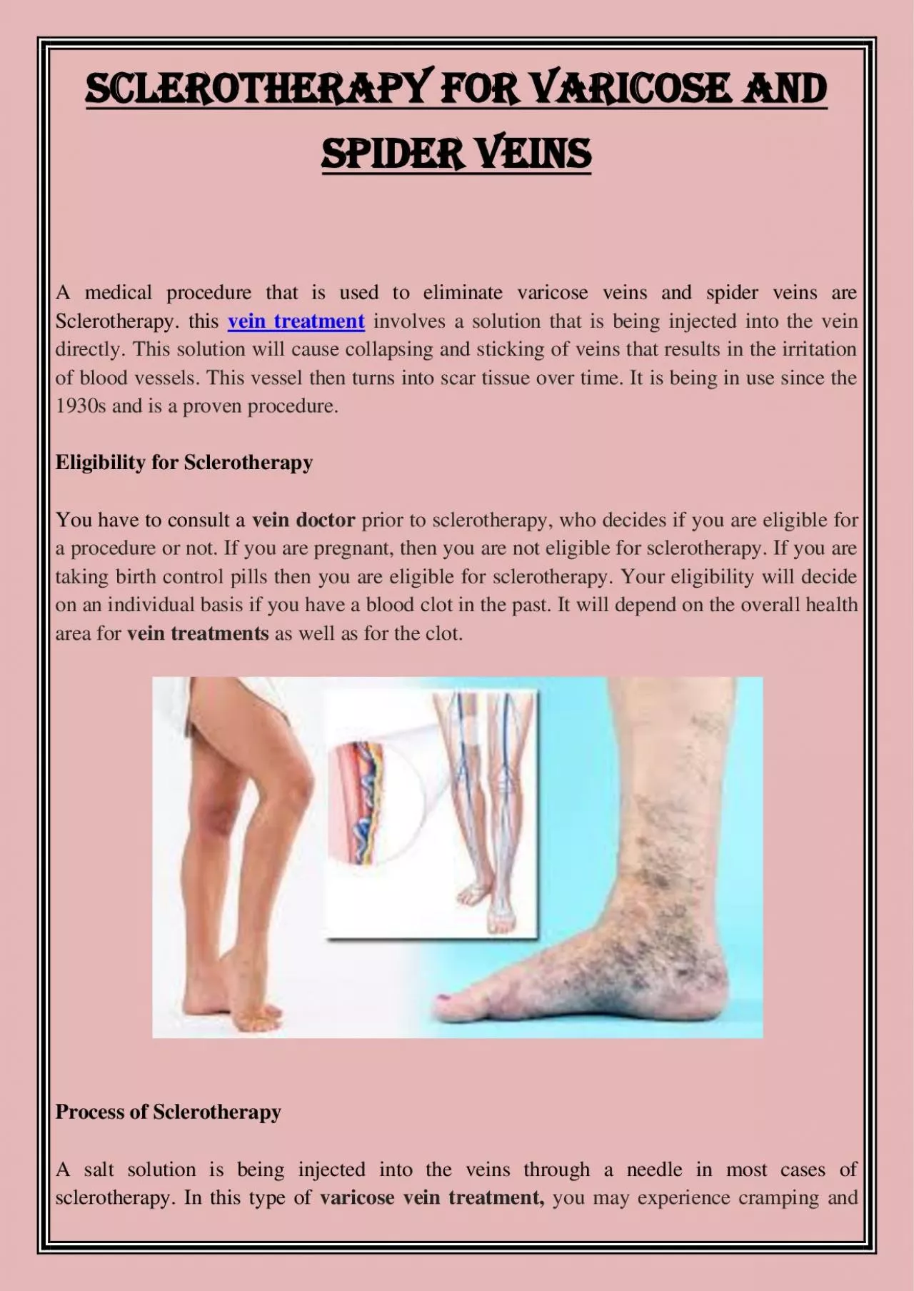 PDF-Sclerotherapy for varicose and spider veins