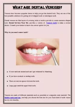 What are Dental Veneers?