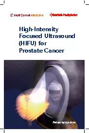 PDF-31e Urologist uses the HIFU device to ablate prostate tissue A pro