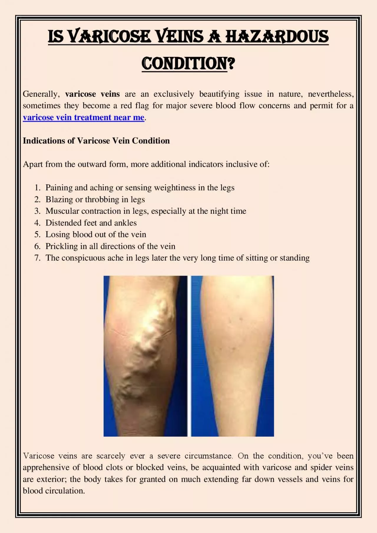 PDF-Is Varicose Veins a Hazardous Condition?