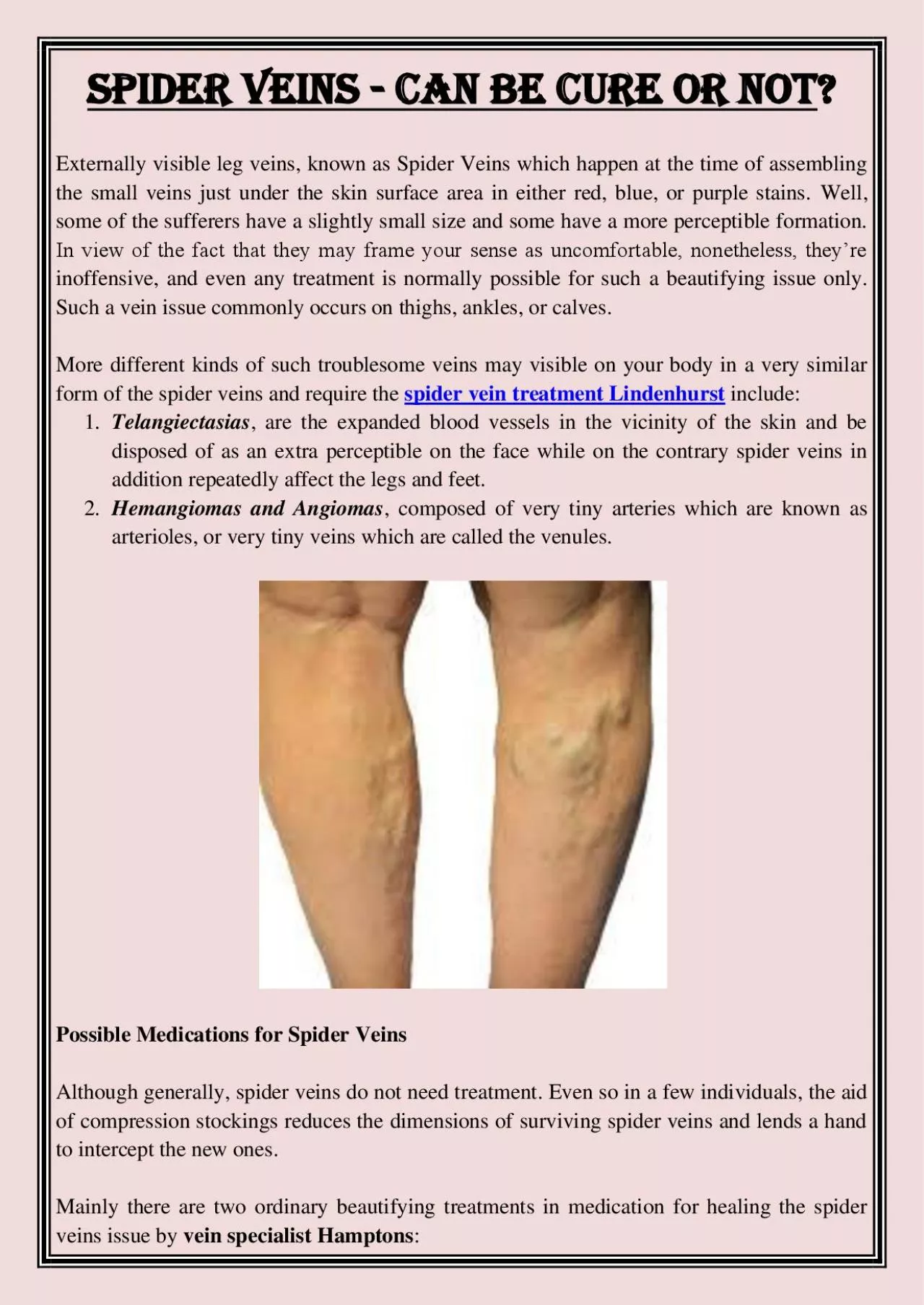 PDF-Spider Veins - Can Be Cure or Not?