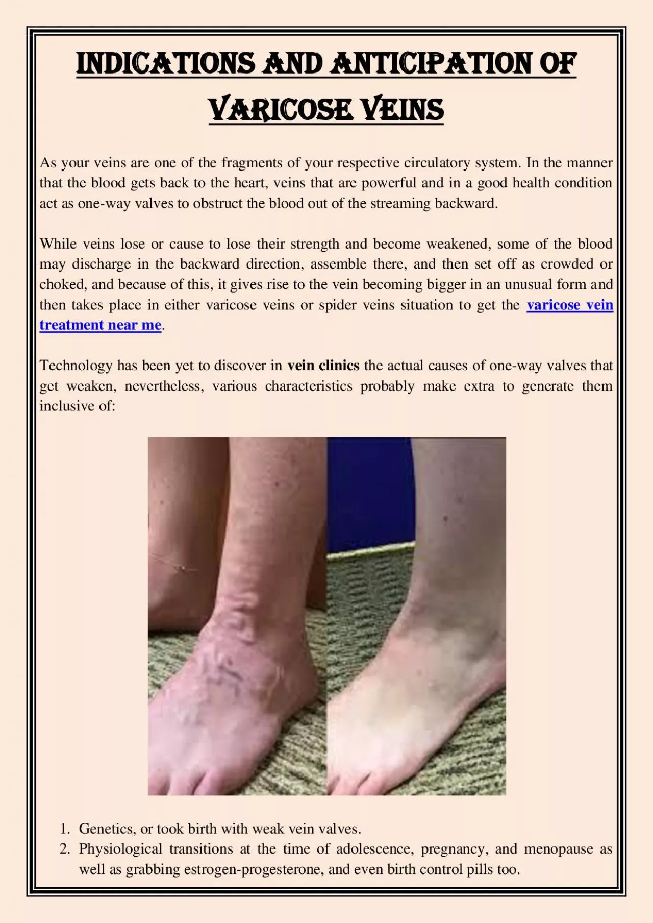 PDF-Indications and Anticipation of Varicose Veins