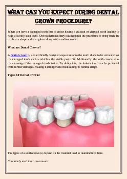 What Can You Expect During Dental Crown Procedure?