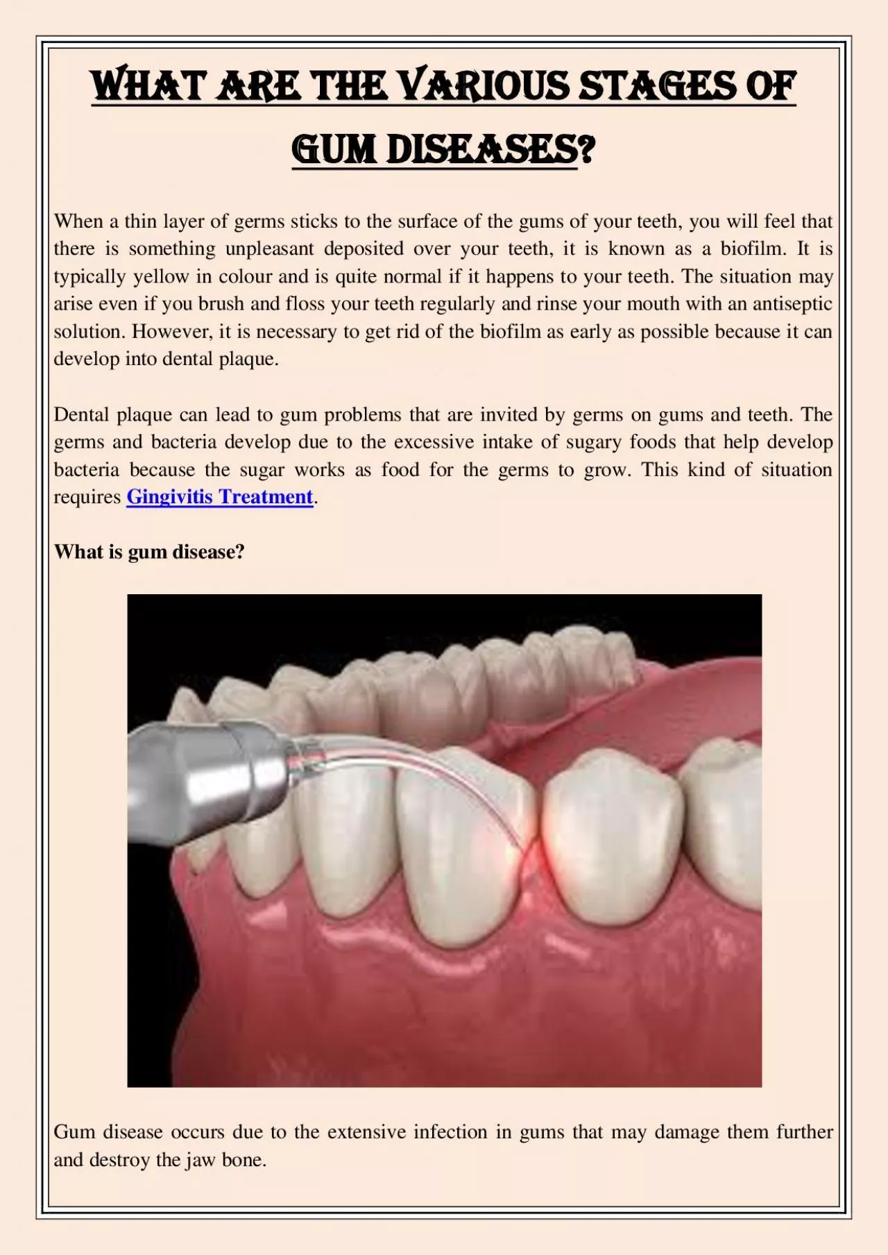 PDF-What are the various Stages of Gum Diseases?