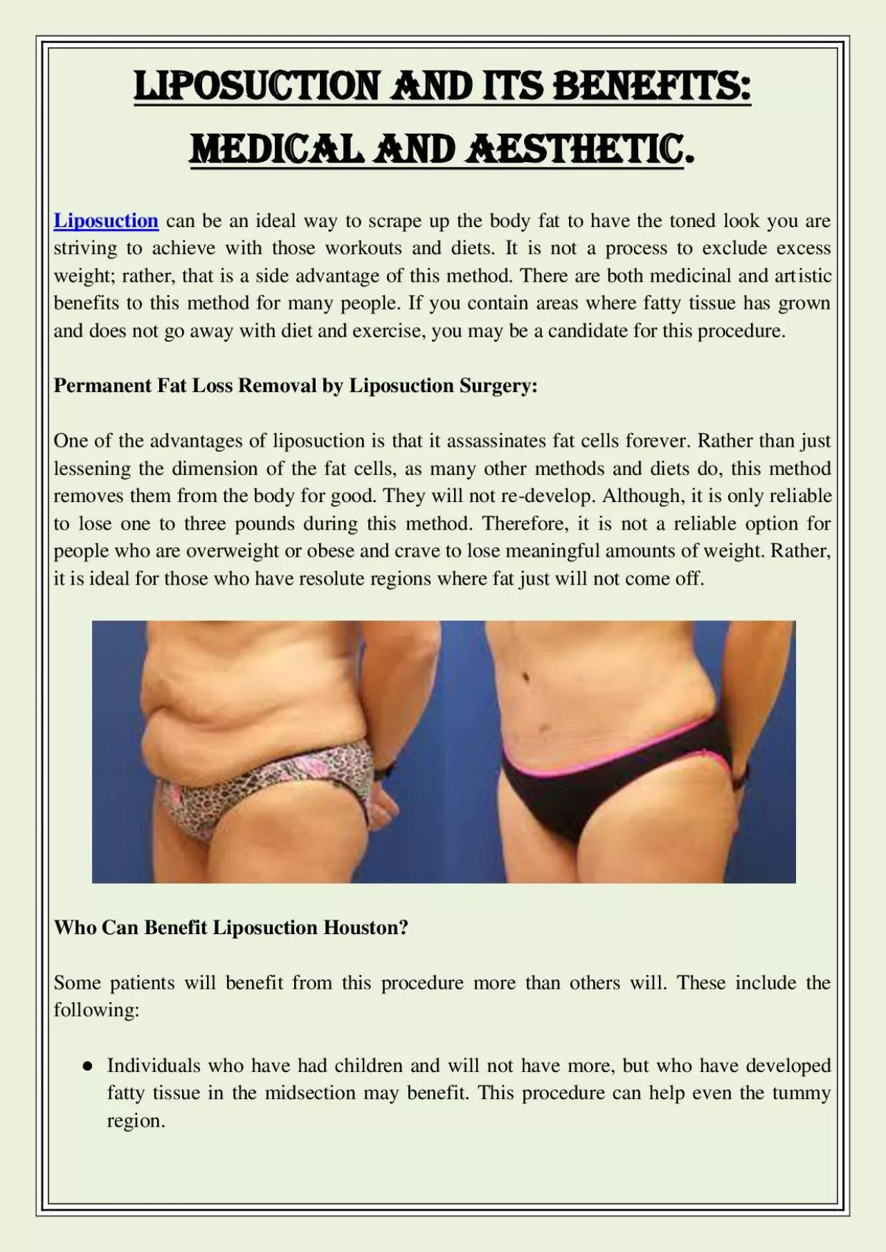 PDF-Liposuction And Its Benefits: Medical And Aesthetic.