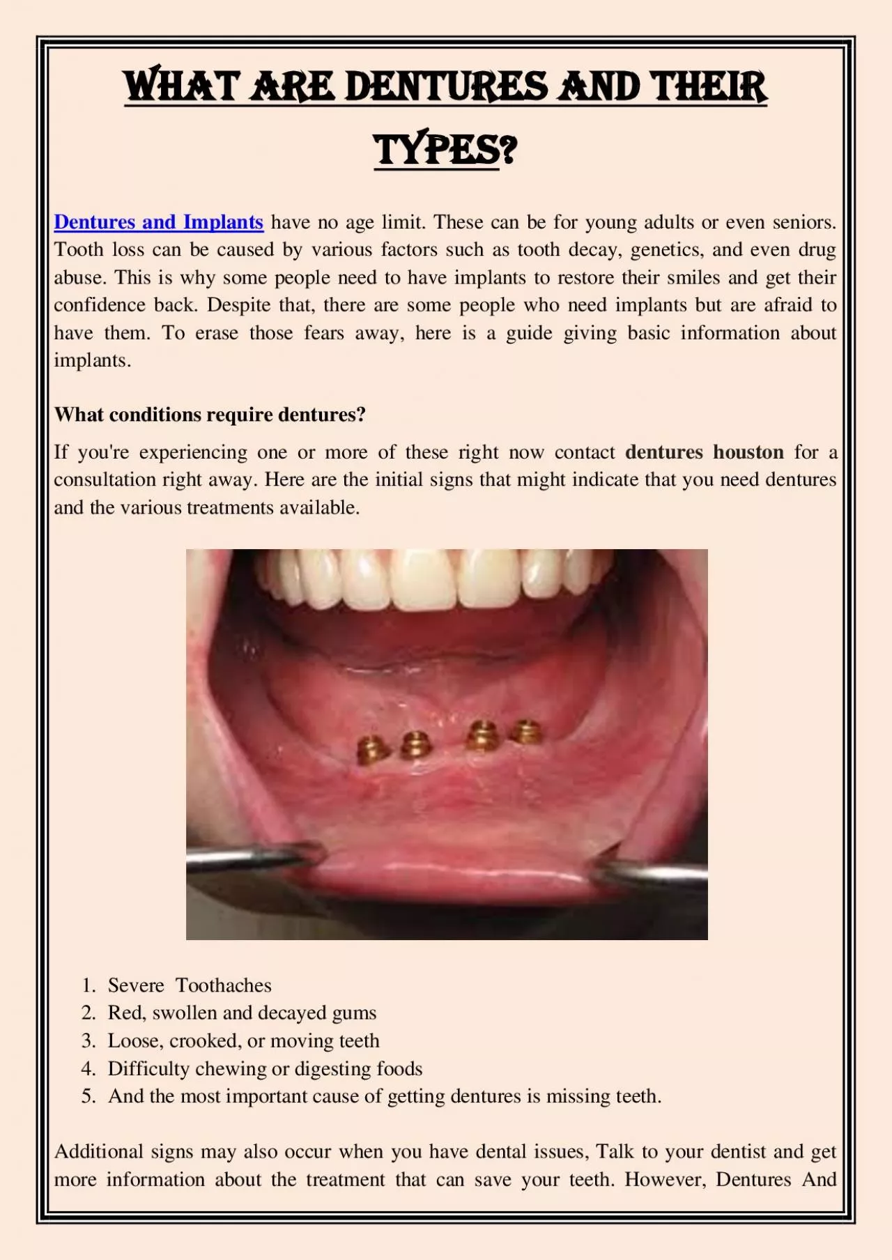 PDF-What are Dentures and Their Types?