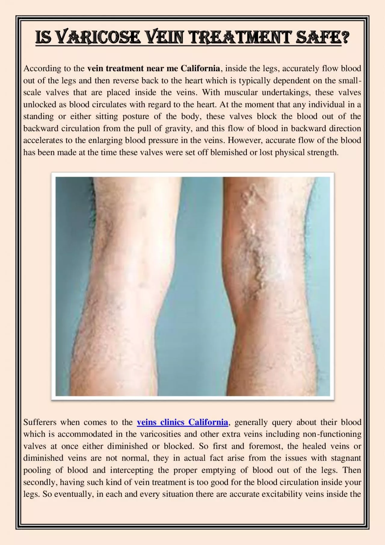 PDF-Is Varicose Vein Treatment Safe?