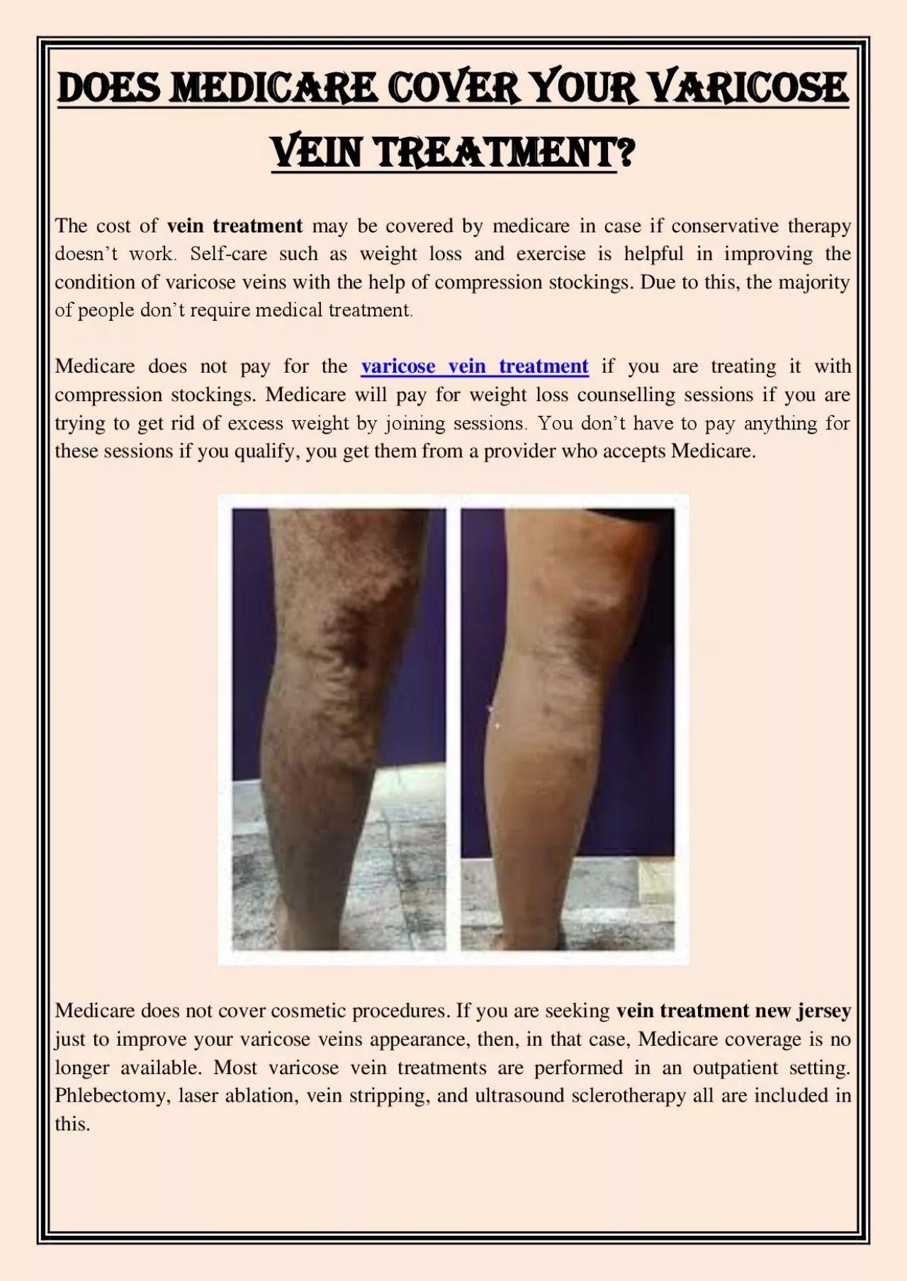 PDF-Does Medicare cover your varicose vein treatment?