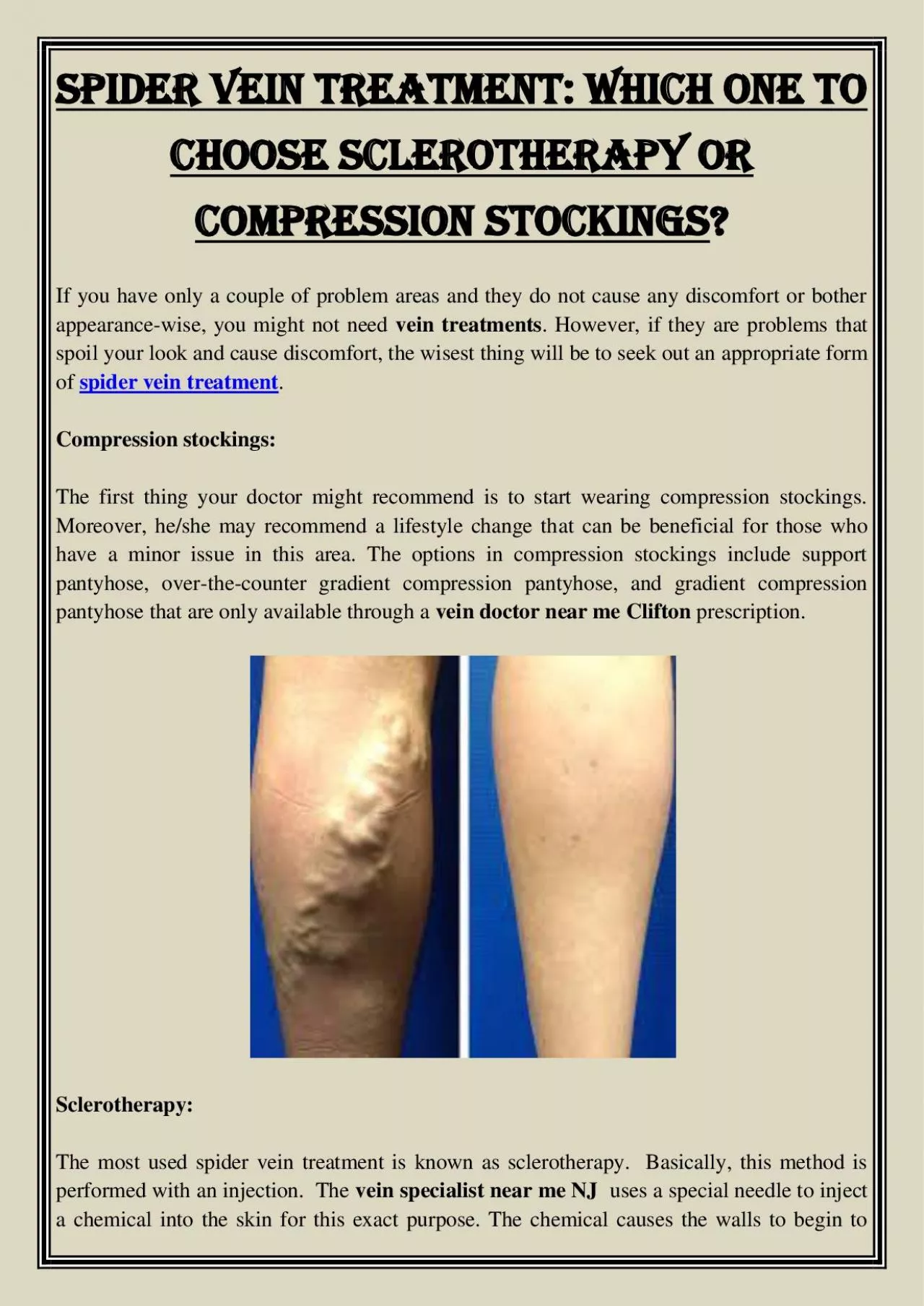 PDF-Spider vein Treatment: Which One To Choose Sclerotherapy Or Compression Stockings?