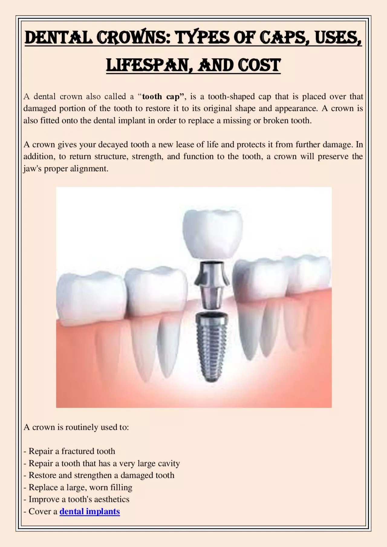 PDF-Dental Crowns: Types of Caps, Uses, Lifespan, and Cost